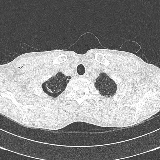 CT-LUNG.jpg